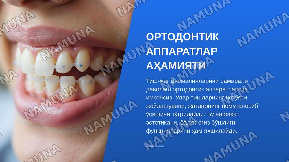 Нансе аппарати. Гошгариан буйича танглай бюгели.QuadHelix, Дерихсвайлер аппарати.Норда аппарати. Лаб бампери, тил ёйи .юз ёйи ( Headgear ,Facebow) — zamonaviy taqdimot, 3-slayd