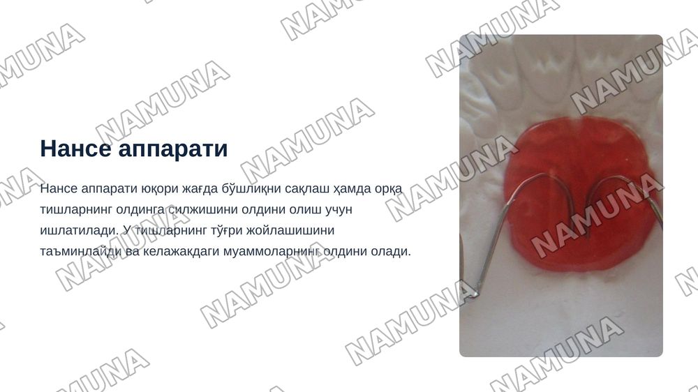 Нансе аппарати. Гошгариан буйича танглай бюгели.QuadHelix, Дерихсвайлер аппарати.Норда аппарати. Лаб бампери, тил ёйи .юз ёйи ( Headgear ,Facebow) — zamonaviy taqdimot, 4-slayd