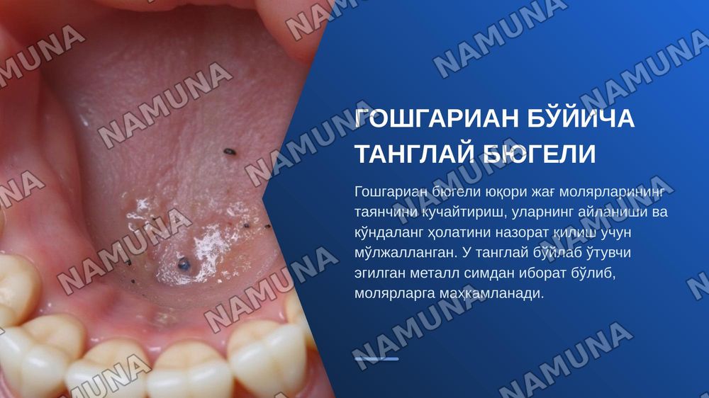 Нансе аппарати. Гошгариан буйича танглай бюгели.QuadHelix, Дерихсвайлер аппарати.Норда аппарати. Лаб бампери, тил ёйи .юз ёйи ( Headgear ,Facebow) — zamonaviy taqdimot, 5-slayd