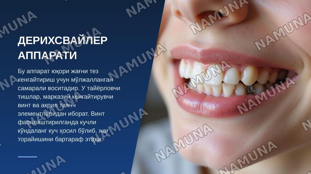 Нансе аппарати. Гошгариан буйича танглай бюгели.QuadHelix, Дерихсвайлер аппарати.Норда аппарати. Лаб бампери, тил ёйи .юз ёйи ( Headgear ,Facebow) — zamonaviy taqdimot, 7-slayd