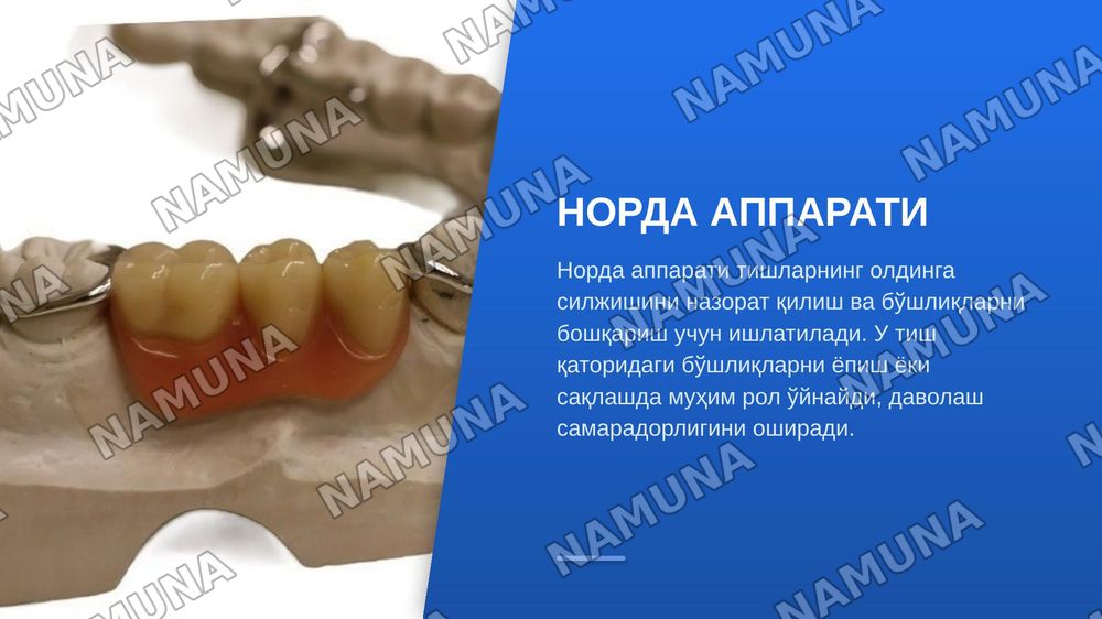 Нансе аппарати. Гошгариан буйича танглай бюгели.QuadHelix, Дерихсвайлер аппарати.Норда аппарати. Лаб бампери, тил ёйи .юз ёйи ( Headgear ,Facebow) — zamonaviy taqdimot, 8-slayd