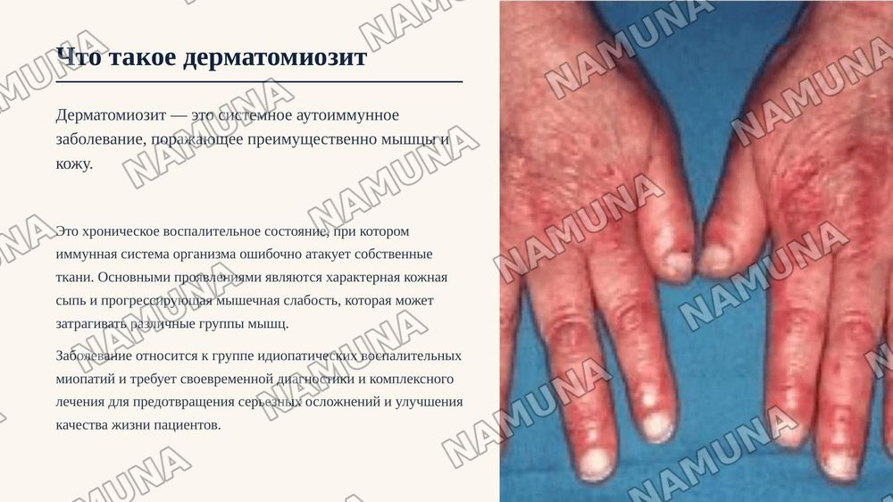 Дерматомизит — zamonaviy taqdimot, 3-slayd