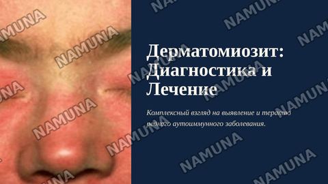 Дерматомизит — zamonaviy taqdimot