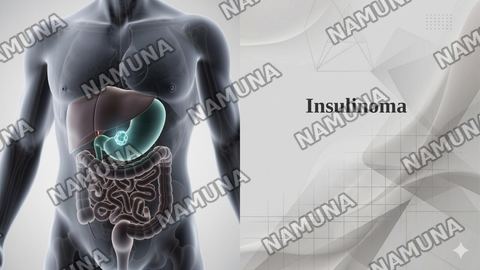 Insulinoma — taqdimot