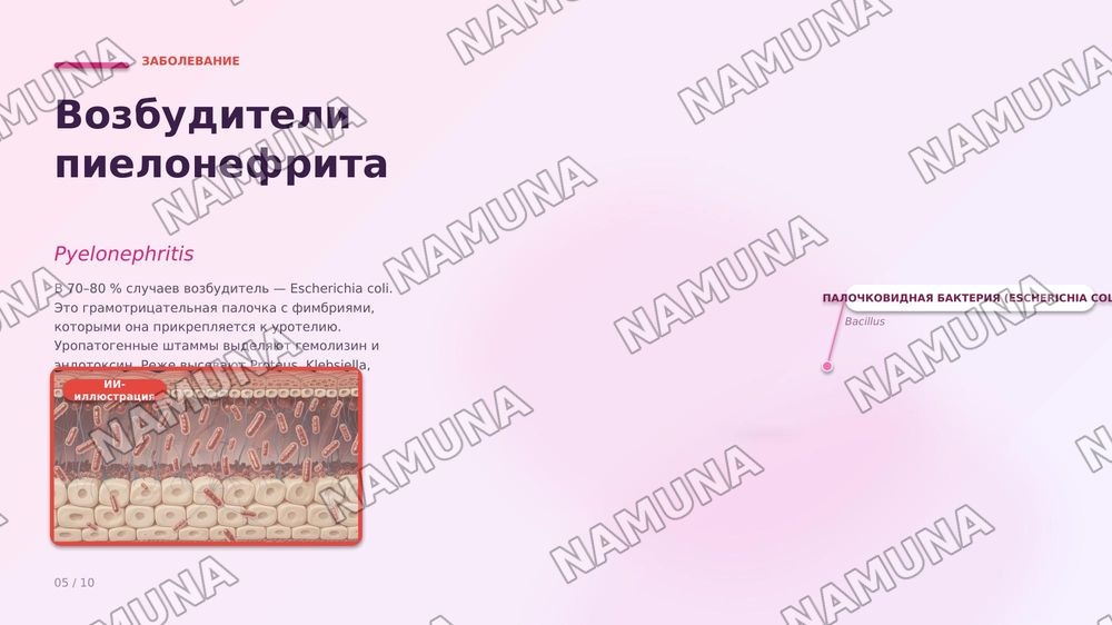 Пиелонефрит. По предмету паралогическая анатомия — zamonaviy taqdimot, 6-slayd