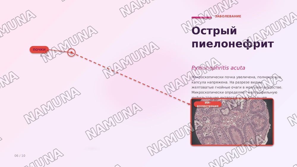 Пиелонефрит. По предмету паралогическая анатомия — zamonaviy taqdimot, 7-slayd
