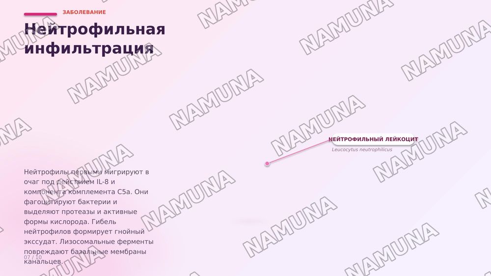 Пиелонефрит. По предмету паралогическая анатомия — zamonaviy taqdimot, 8-slayd