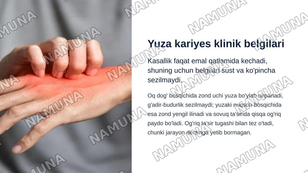Yuza kariyes.
1.Yuza  kariesni etiologiyasi, patogenezi, klinikasi, diagnostika va davolash usullari. Yuza kariesni qiyosiy tashxislash.
2 — zamonaviy taqdimot, 4-slayd