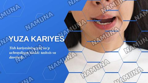 Yuza kariyes.
1.Yuza  kariesni etiologiyasi, patogenezi, klinikasi, diagnostika va davolash usullari. Yuza kariesni qiyosiy tashxislash.
2 — zamonaviy taqdimot