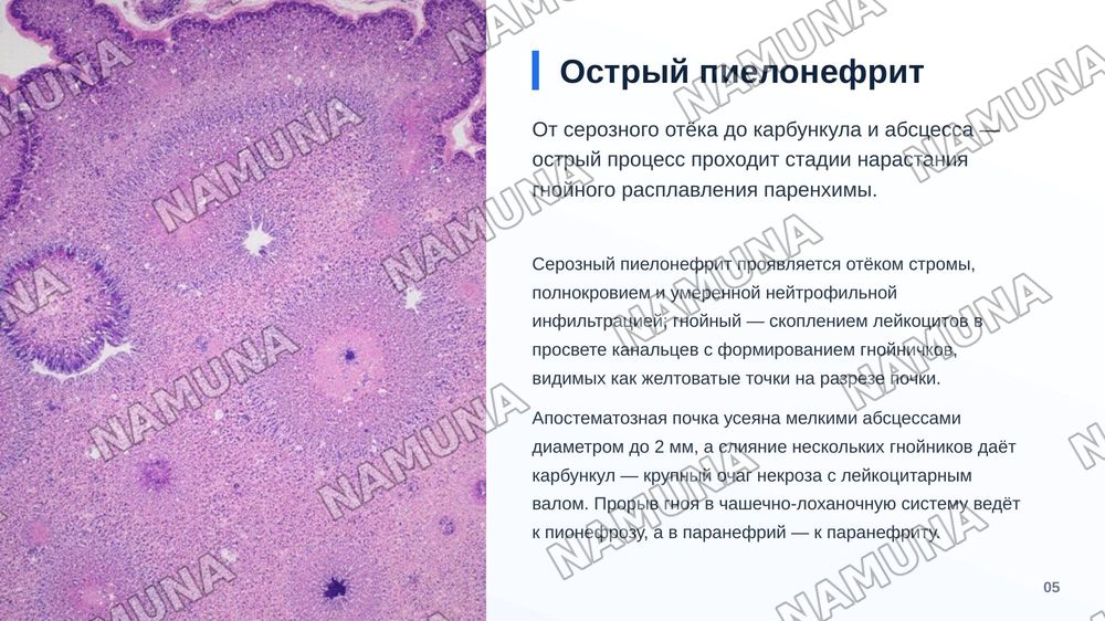 Пиелонефрит. По предмету патологическая анатомия — zamonaviy taqdimot, 6-slayd