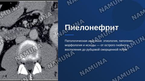 Пиелонефрит. По предмету патологическая анатомия — zamonaviy taqdimot