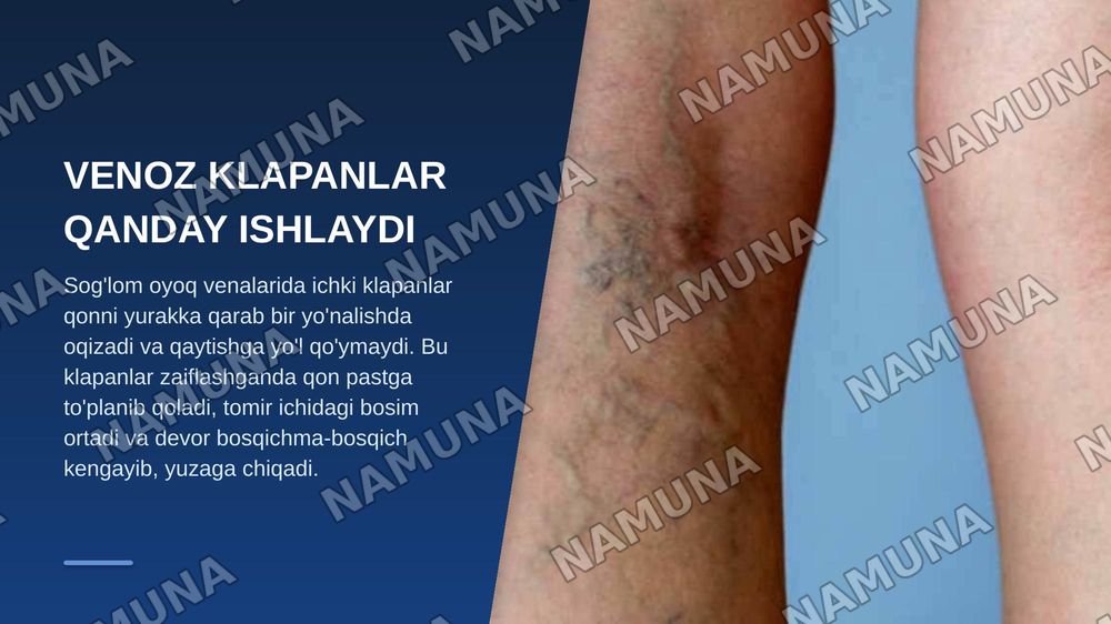 Oyoq qollarda qon aylanish faoliyatining buzulish sindromi varikoz — zamonaviy taqdimot, 4-slayd