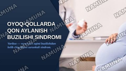 Oyoq qollarda qon aylanish faoliyatining buzulish sindromi varikoz — zamonaviy taqdimot