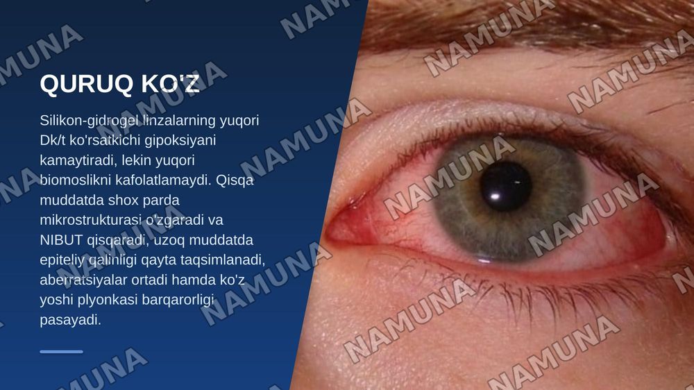 MIOPIYANI KONTAKTLI KORREKSIYA QILISHDA QURUQ KO'Z SINDROMI VA KO'Z OLDINGI SEGMENTINING KLINIK-MORFOMETRIK O'ZGARISHLARI — zamonaviy taqdimot, 5-slayd