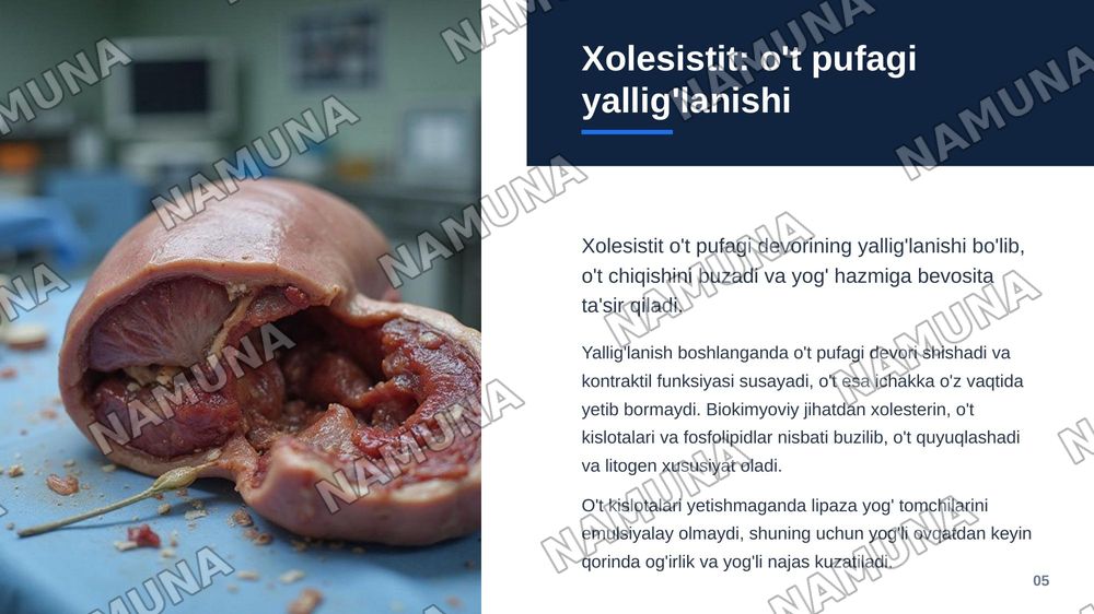 Surunkali gepatitlar.
Xolesistitda yoglar hazmlanishini buzulishi(steyatoreya) — zamonaviy taqdimot, 6-slayd