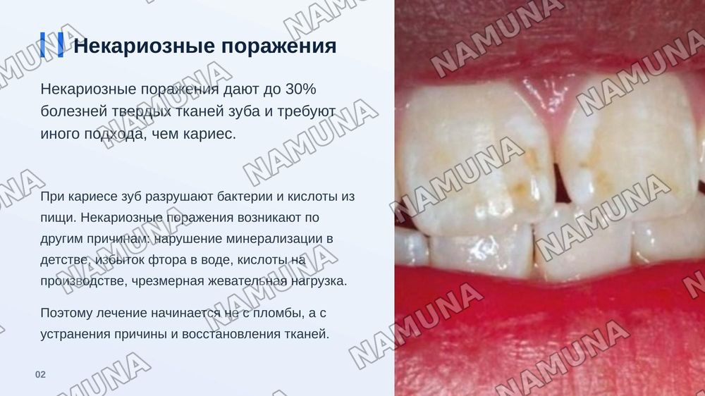 Классификации некариозных заболеваний твердых тканей зуба (классификация Патреева и другие классификации). — zamonaviy taqdimot, 3-slayd