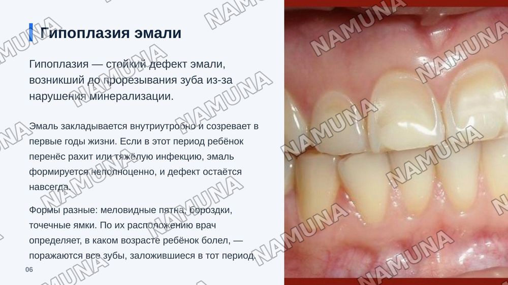 Классификации некариозных заболеваний твердых тканей зуба (классификация Патреева и другие классификации). — zamonaviy taqdimot, 7-slayd