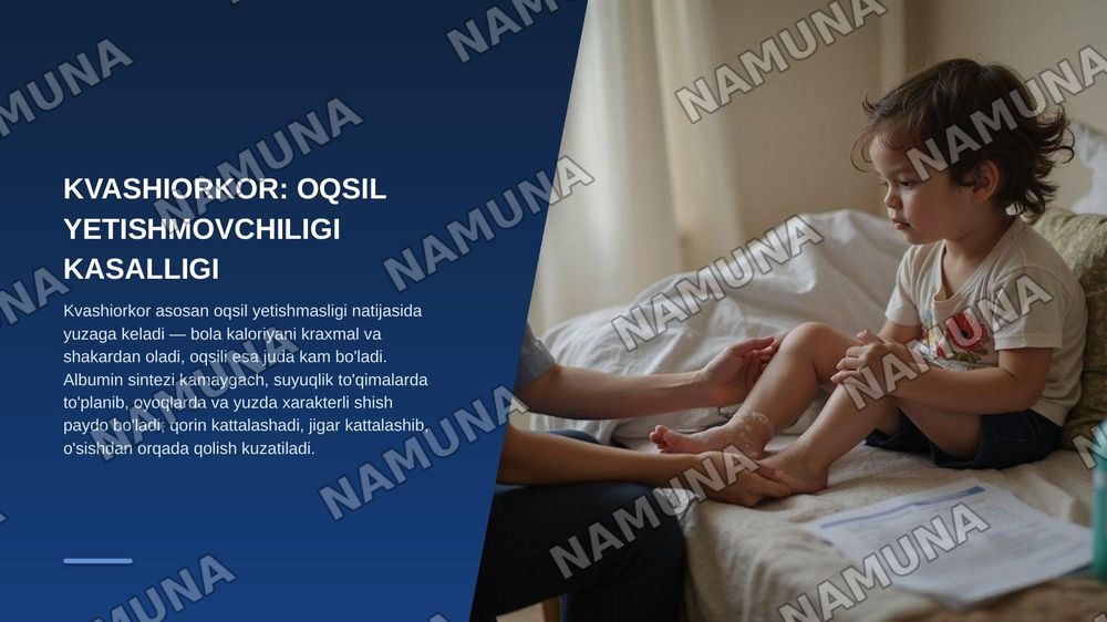 Oqsil almashinuvi patologiyasining umumiy jihatlari.
1.Kvashiorkor, alimentar marazm 2.Podagra. Kelib chiqish sabablari, alomatlari, profilaktikasi. Bu kasalliklarning olgini olishda to’g’ri ovqatlanishning ahamiyati. — zamonaviy taqdimot, 5-slayd