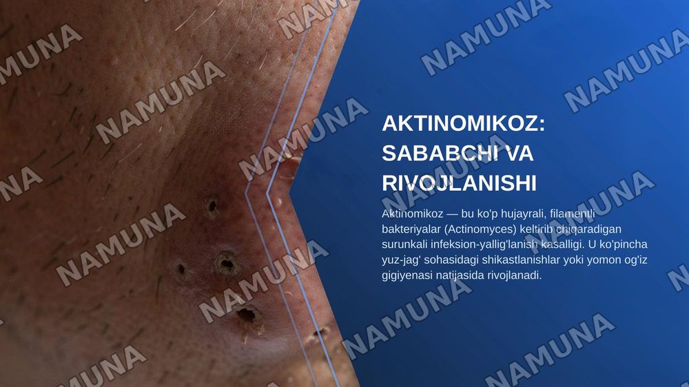 Yuz-jag‘ sohasining infeksion-yallig‘lanish kasalliklari: aktinomikoz, zaxm va sil. Klinikasi, diagnostikasi va differensial diagnostikasi. — zamonaviy taqdimot, 5-slayd