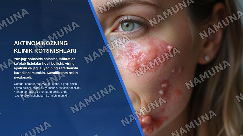 Yuz-jag‘ sohasining infeksion-yallig‘lanish kasalliklari: aktinomikoz, zaxm va sil. Klinikasi, diagnostikasi va differensial diagnostikasi. — zamonaviy taqdimot, 6-slayd