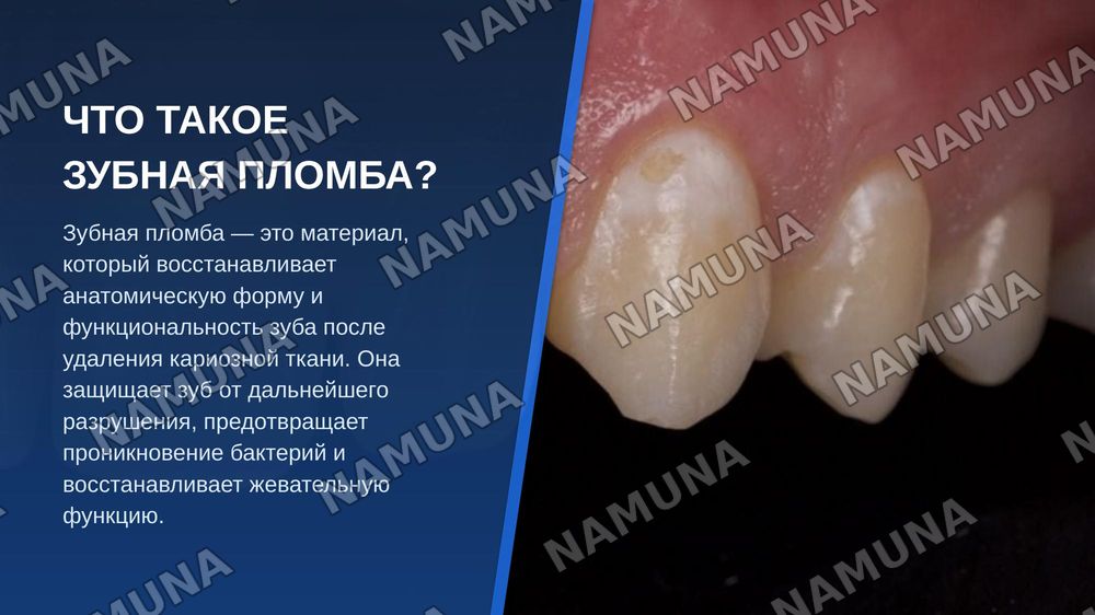 Пломбы — zamonaviy taqdimot, 4-slayd