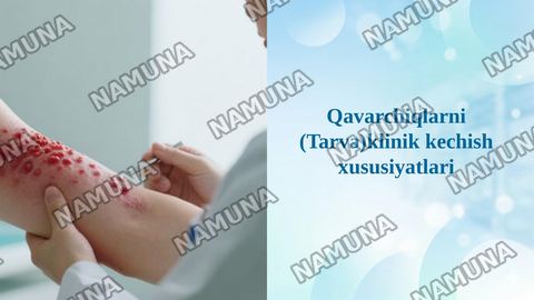 Qavarchiqlarni (Tarva)klinik kechish xususiyatlari — taqdimot