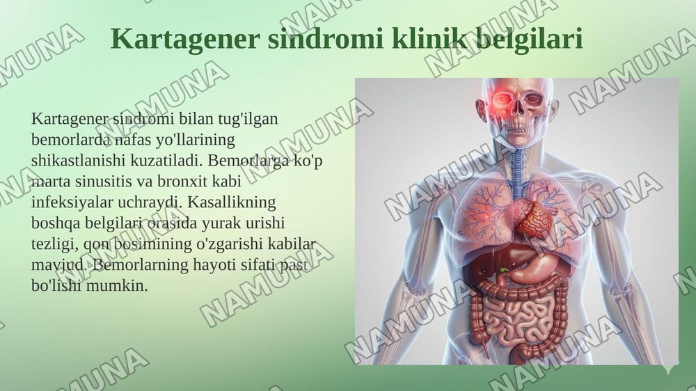 Kartagener sindromi — 5-slayd