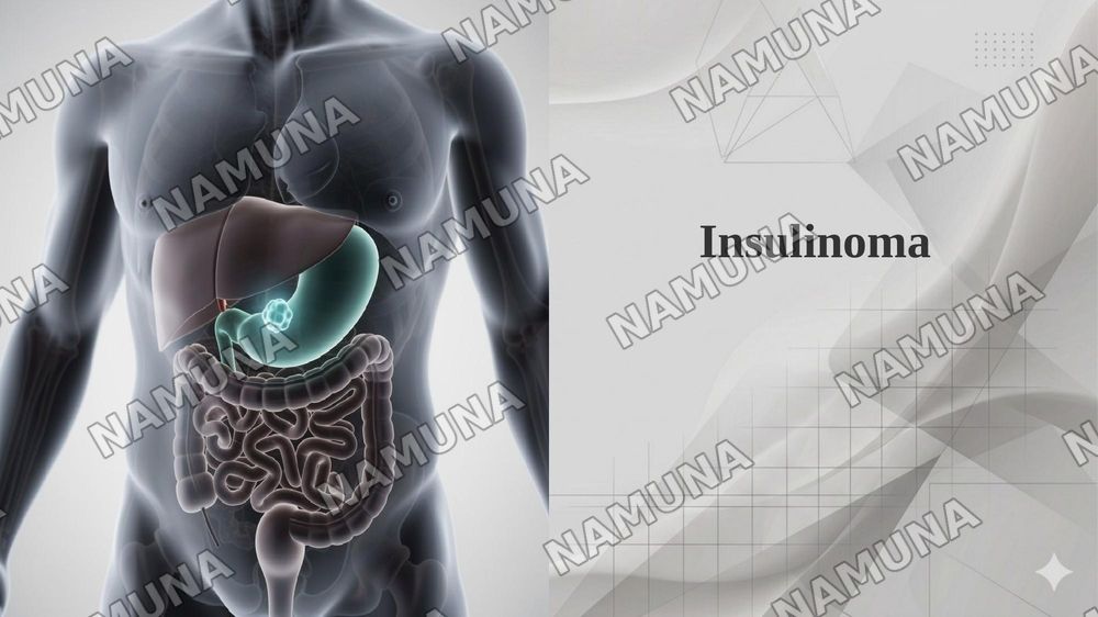 Insulinoma — 1-slayd