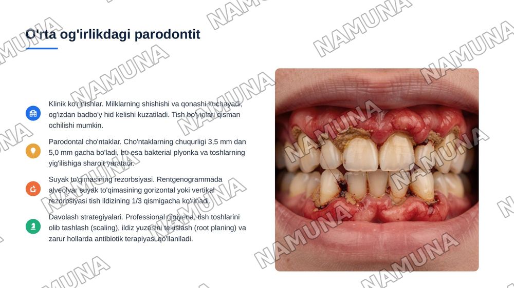 Parodontit. Yengil, o’rta va og‘ir shakllari. Klinikasi, qiyosiy tashxisi.
Parodontoz. Klinikasi, qiyosiy tashxisi. Parodontning idiopatik 6 kasalliklari. Klinikasi, qiyosiy tashxisi, davolash. Davolashda
stomatolog o‘rni. Kasallik tarixini yozis — 7-slayd